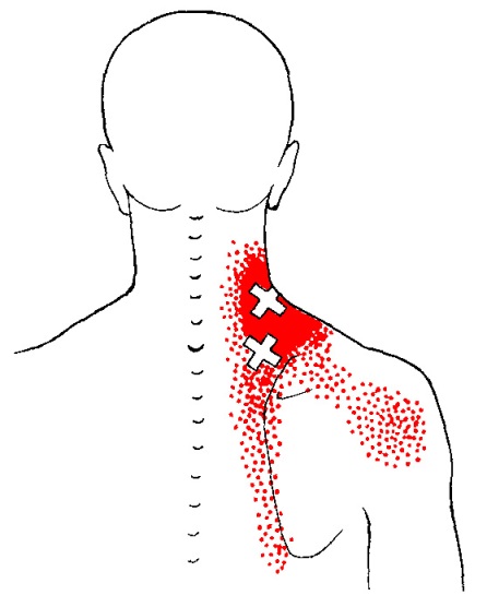 Trigger Point Referral Charts В© Copyright American Academy of